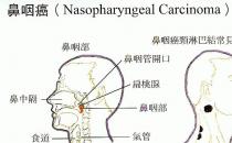 鼻咽癌的早期癥狀有哪些？