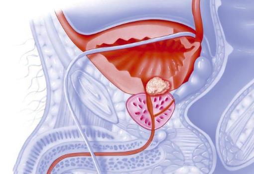 男人冬天容易得前列腺炎的原因 冬天保養(yǎng)尤其重要