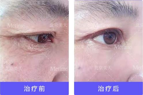 熱瑪吉抗衰(Thermage)官方認證中國指定操作醫(yī)生—北京美天張潘院長