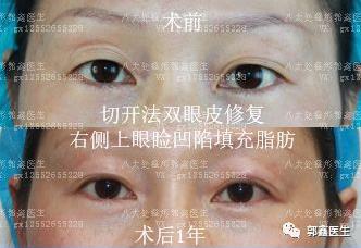 八大處整形郭鑫：上眼瞼凹陷脂肪填充圖片